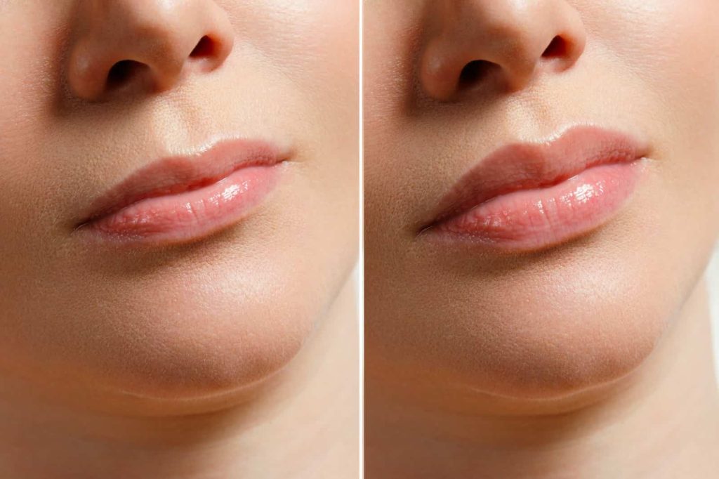 before and after lip augmentation treatment in Indore