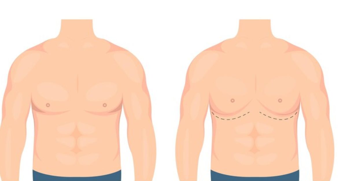 gynecomastia surgeon in Indore