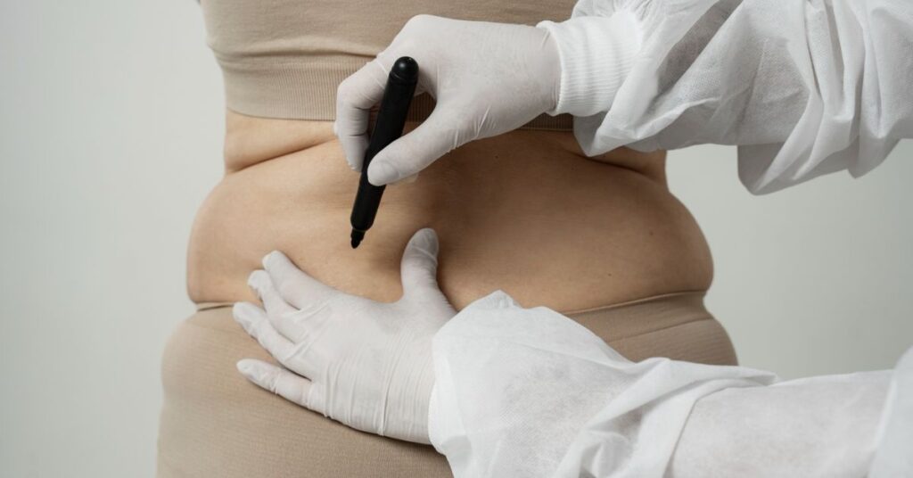 liposuction surgery in Indore, liposuction surgeon in Indore